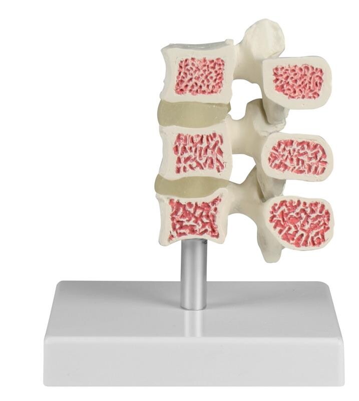Osteoporos kotor modell, 3 kotor