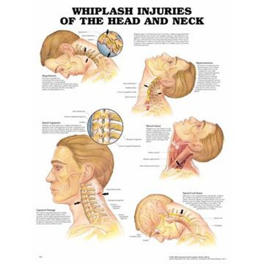 Pisksnärtsskada laminerad affisch engelsk (Whiplash injuries)