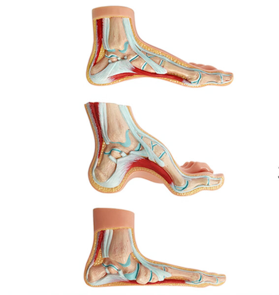 3 fot modeller, Anatomiskt av normal fot, en plattfot och en fot med högt fotvalv